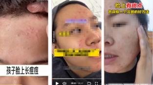 請勿使用痘痘/斑點成團成簇影響用戶體驗的素材設(shè)計，如【視頻中展現(xiàn)痘痘點形象泛紅成簇、斑點密集場景】，請修改